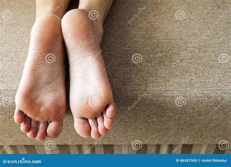 Dry Cracked Skin Of Woman Feet In Bed Foot Treatment Stock Photo