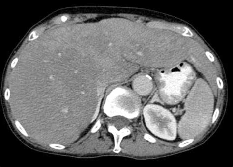 The Ct Scan Reduced Hepatic Perfusion In Enlarged Liver After