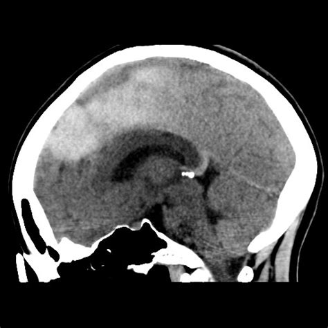 Parafalcine Subdural Hemorrhage Image