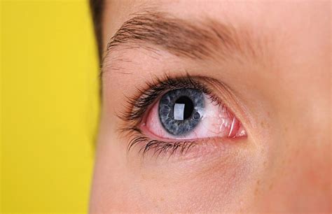 Symptoms And Causes Of Sore Eyes Top Treatments To Keep Your Eyes