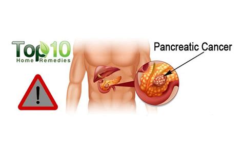 10 Warning Signs Of Pancreatic Cancer That You Must Know Top 10 Home