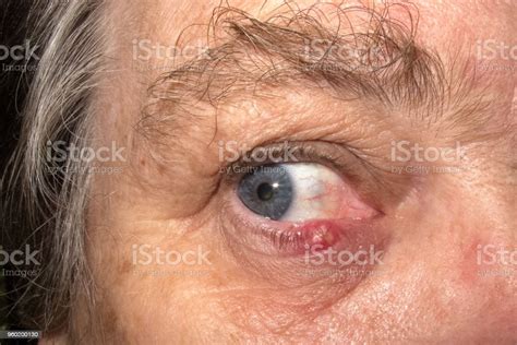 Older Woman With Eye Infection Stock Photo Download Image Now Istock