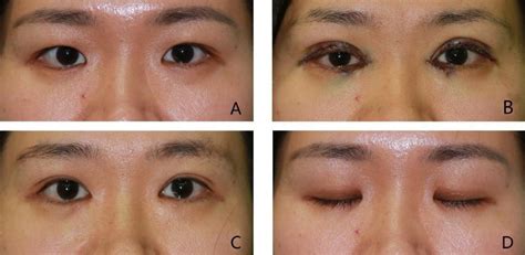 References In Double Eyelid Surgery By Using Palpebral Marginal