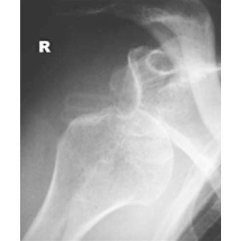Pdf Open Screw Fixation Of Large Anterior Glenoid Rim Fractures Mid
