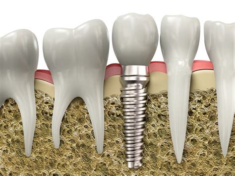 Benefits Of Dental Implants Richmond Va Davey Crockett Dentistry