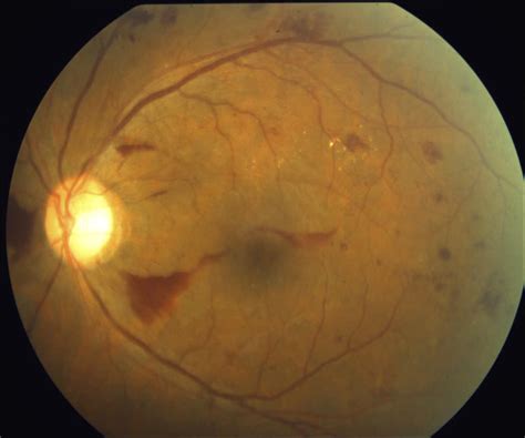 diabetic retinopathy hawaii diabetic retinopathy
