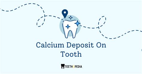 The Dental Nightmare We All Know As Calcium Deposit On Tooth Teethopedia