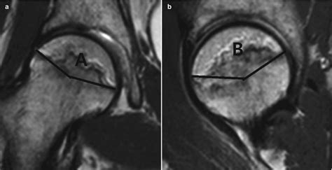 Hip Magnetic Resonance Imaging Recon Orthobullets