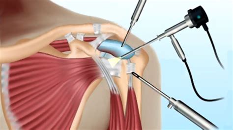Cirugía Artroscopia De Hombro En Valencia Clínica Jaime I Catarroja
