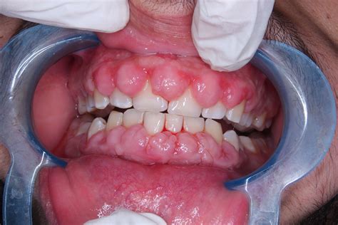 Ce Activity Drug Induced Gingival Overgrowth Dentist