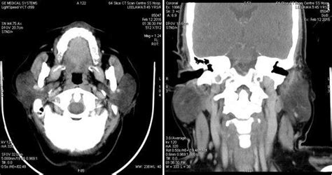 A Coronal And B Axial Ct Scan Of Patient Showing Bilateral Parotid