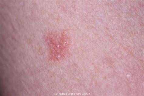 Early Signs Of Skin Cancer On Arm