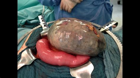 Want to learn more about it? Volvulus du sigmoide - YouTube