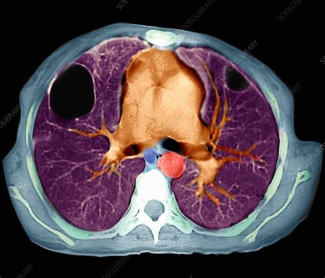 Lung Abscesses Ct Scan Stock Image M1080547 Science Photo Library