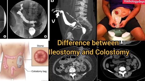Whats The Difference Between Ileostomy And Colostomy Ctscan Whats The Stoma Bag Radiologydept