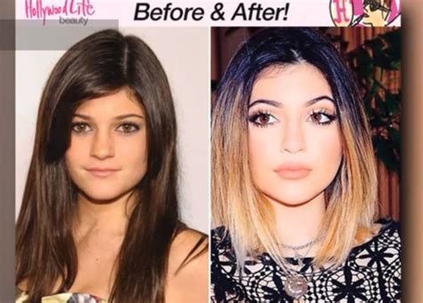 Kylie Jenner Prima E Dopo Chirurgia Plastica Foto E Video Ladyblitz