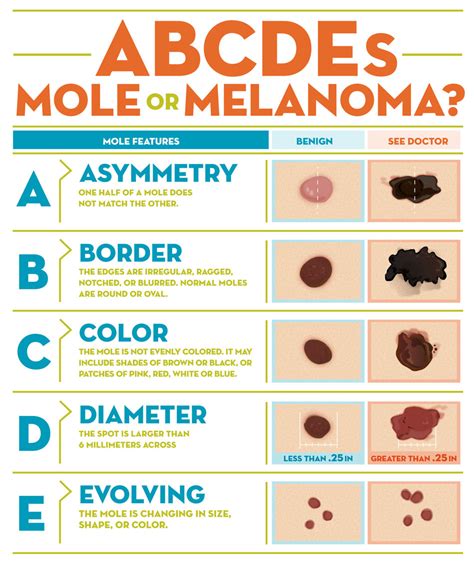 Chart Abcde Melanoma The Abcde Rule Of Skin Cancer Afd Get The My Xxx
