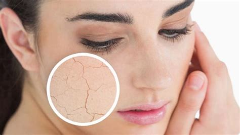 Dry Skin Vs Dehydrated Skin How To Know The Difference