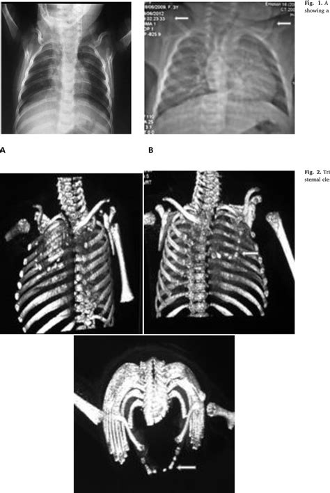 Total Congenital Sternal Cleft Isolated In A Newborn Of 20 Days Rare