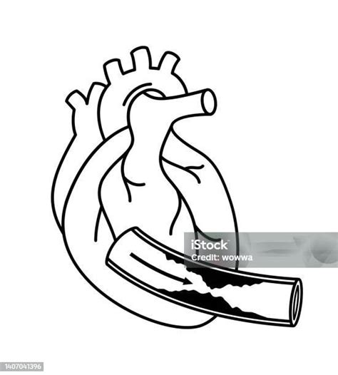 Human Heart With Coronary Artery Disease Stock Illustration Download