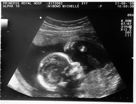 Michael And Michelle 20 Weeks Scan