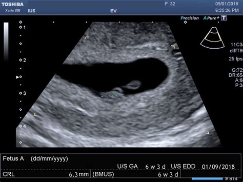 6 Week Pregnancy Scan 6 Week Ultrasound 6 Week Scan 6 Week Scan