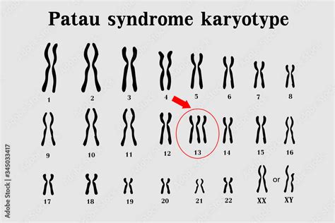 Patau Syndrome Karyotype Is The One Of Chromosomal Disorders That Have Extra Copy Of Chromosome