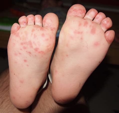 Foot Diseases Spread To The Federation The Manchineel