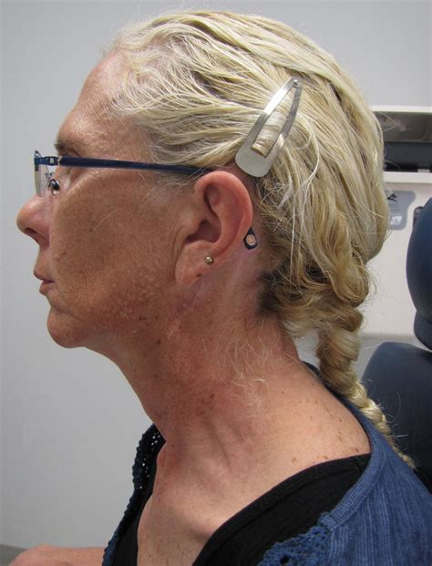 Case Example Posterolateral Neck Dissection Iowa Head And Neck Protocols