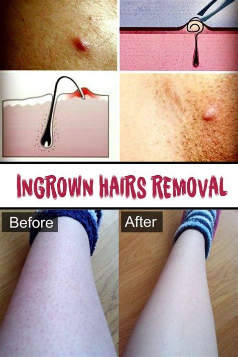 Ingrown Hairs Removal Ingrownhaironvagina Ingrown Hair Removal Ingrown Hair Leg Hair Removal