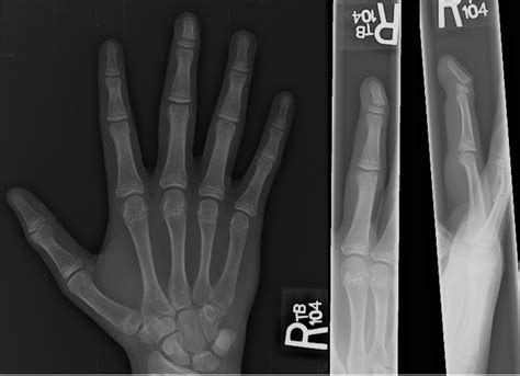 Mallet Fracture X Ray Mallet Finger Litfl Trauma Library A Hand