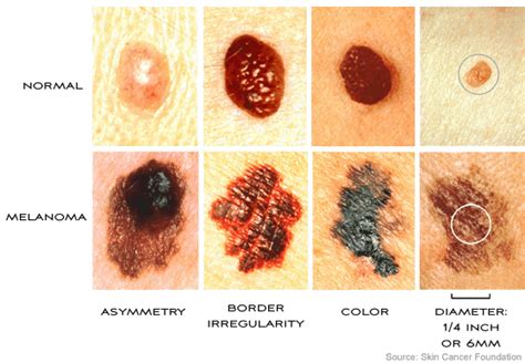 Skin Expert Melanoma Screening Is The Best Prevention