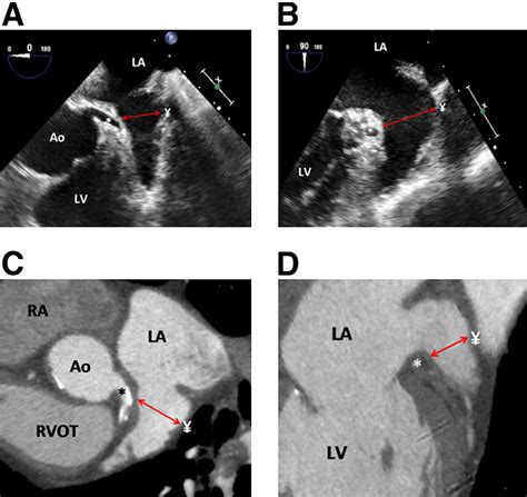 Imaging The Left Atrial Appendage Prior To During And After Occlusion