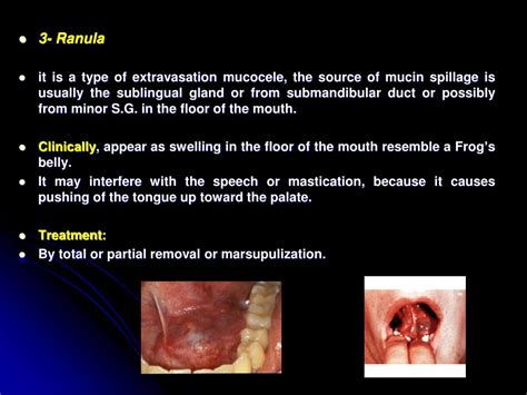 Ppt Salivary Gland Diseases Powerpoint Presentation Free Download