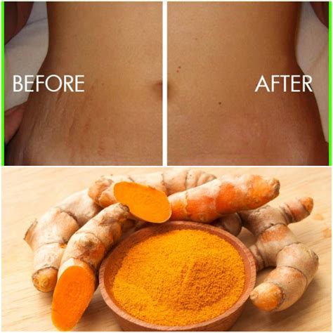 How To Cure Stretch Marks Using Turmeric Fabwoman