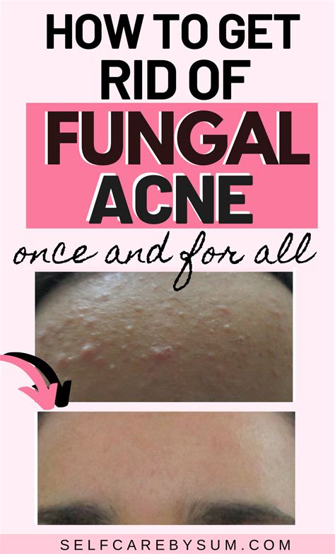 How To Finally Get Rid Of Fungal Acne Sbs In 2021 Forehead Bumps