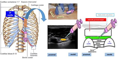 Bloqueo De Las Ramas Cutáneas Anteriores De Los Nervios Intercostales