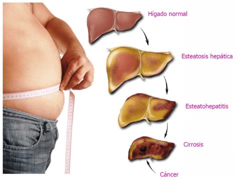 LA CIRROSIS CAUSAS SÍNTOMAS Y TRATAMIENTO CON GANODERMA LUCIDUM