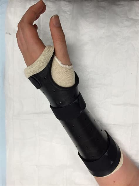 Custom Splints And Casts For Injuries Action Rehab