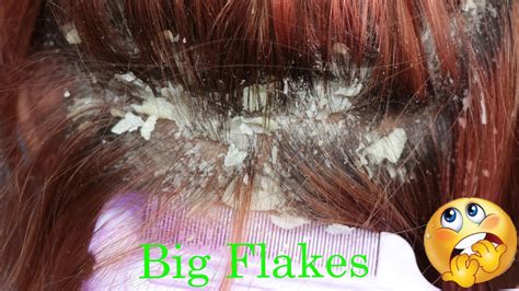 Amazing Huge Flakes Scratching Dandruff Off Scalp Big Flakes Itchy Dry
