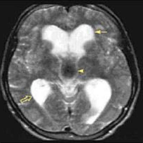 Normal pressure hydrocephalus characteristically presents with progressive gait impairment, cognitive deficits, and urinary urgency and/or incontinence. (PDF) The Triad of Idiopathic Normal-Pressure ...