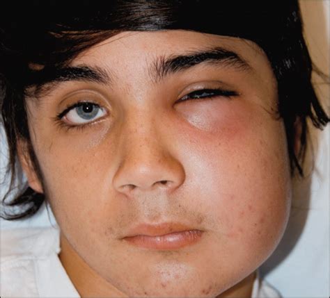 Facial Cellulitis Causes Symptoms And Treatment Icd 10 Cellulitis Pictures