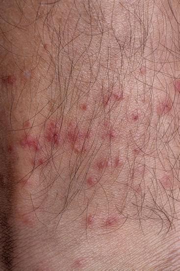 Allergic Reactions To Tick Bites Photos By Canva