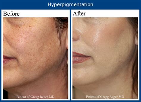 How To Get Rid Of Hyper Pigmentation