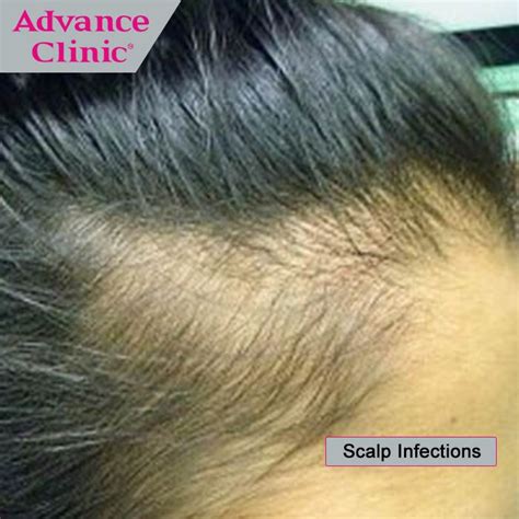 Hair Loss Fungal Hair Scalp And Nail Conditions Types Causes And