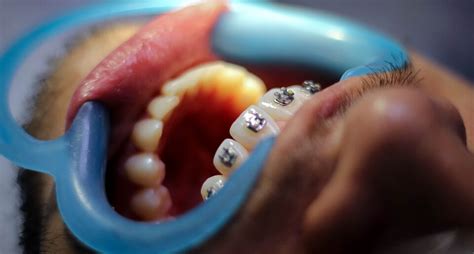 The Woman Broke Into The Dentist S Office And Pulled Out 13 Teeth Of The Patient Ordo News