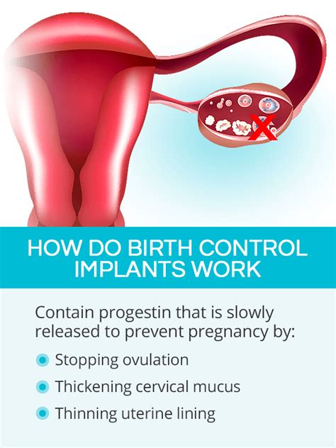Birth Control Implant SheCares 17100 Hot Sex Picture