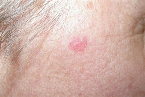 This webmd slideshow tells you how to spot the early warning signs of skin cancer and seek treatment. Cream could be surgery alternative for some skin cancer ...