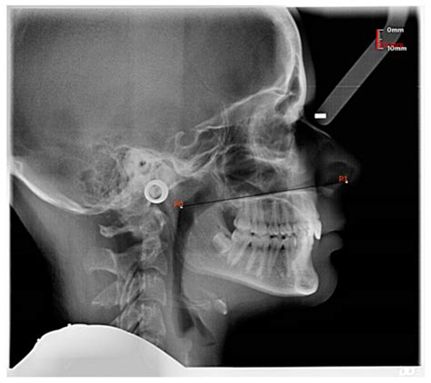 Jcm Free Full Text Cross Sectional Study On Lateral Skull
