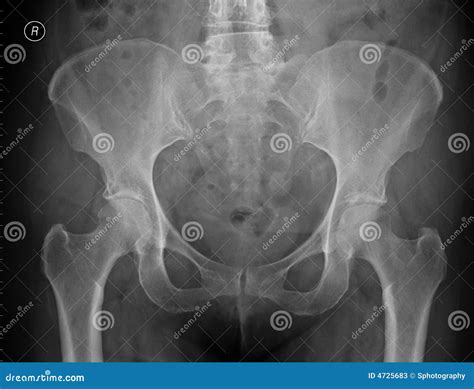 Plain X Ray Of The Pelvis Stock Photos Image 4725683